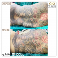 S__131678503.jpg - ดูดไขมัน แผลเล็กมาก เจ็บน้อย ชิวชิว ไม่ต้องวางยา | https://ptinfinity.com