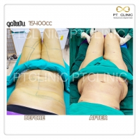 S__131678505.jpg - ดูดไขมัน แผลเล็กมาก เจ็บน้อย ชิวชิว ไม่ต้องวางยา | https://ptinfinity.com