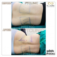 S__131678506.jpg - ดูดไขมัน แผลเล็กมาก เจ็บน้อย ชิวชิว ไม่ต้องวางยา | https://ptinfinity.com