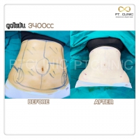 S__131678507.jpg - ดูดไขมัน แผลเล็กมาก เจ็บน้อย ชิวชิว ไม่ต้องวางยา | https://ptinfinity.com