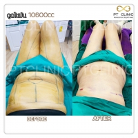 S__131678508.jpg - ดูดไขมัน แผลเล็กมาก เจ็บน้อย ชิวชิว ไม่ต้องวางยา | https://ptinfinity.com