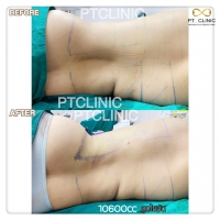 S__131678509.jpg - ดูดไขมัน แผลเล็กมาก เจ็บน้อย ชิวชิว ไม่ต้องวางยา | https://ptinfinity.com