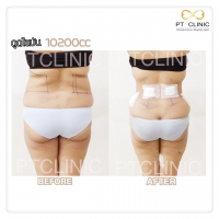 S__131678511.jpg - ดูดไขมัน แผลเล็กมาก เจ็บน้อย ชิวชิว ไม่ต้องวางยา | https://ptinfinity.com