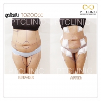 S__131678512.jpg - ดูดไขมัน แผลเล็กมาก เจ็บน้อย ชิวชิว ไม่ต้องวางยา | https://ptinfinity.com