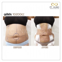 S__131678513.jpg - ดูดไขมัน แผลเล็กมาก เจ็บน้อย ชิวชิว ไม่ต้องวางยา | https://ptinfinity.com