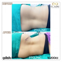 S__131678514.jpg - ดูดไขมัน แผลเล็กมาก เจ็บน้อย ชิวชิว ไม่ต้องวางยา | https://ptinfinity.com