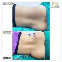 S__131678516.jpg - ดูดไขมัน แผลเล็กมาก เจ็บน้อย ชิวชิว ไม่ต้องวางยา | https://ptinfinity.com