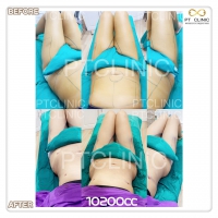 S__131678517.jpg - ดูดไขมัน แผลเล็กมาก เจ็บน้อย ชิวชิว ไม่ต้องวางยา | https://ptinfinity.com