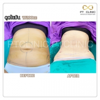 S__131678518.jpg - ดูดไขมัน แผลเล็กมาก เจ็บน้อย ชิวชิว ไม่ต้องวางยา | https://ptinfinity.com