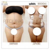 S__131678520.jpg - ดูดไขมัน แผลเล็กมาก เจ็บน้อย ชิวชิว ไม่ต้องวางยา | https://ptinfinity.com