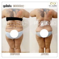 S__131678522.jpg - ดูดไขมัน แผลเล็กมาก เจ็บน้อย ชิวชิว ไม่ต้องวางยา | https://ptinfinity.com