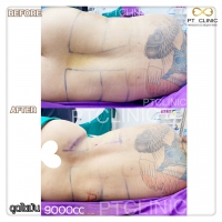 S__131678524.jpg - ดูดไขมัน แผลเล็กมาก เจ็บน้อย ชิวชิว ไม่ต้องวางยา | https://ptinfinity.com