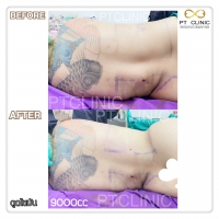 S__131678525.jpg - ดูดไขมัน แผลเล็กมาก เจ็บน้อย ชิวชิว ไม่ต้องวางยา | https://ptinfinity.com