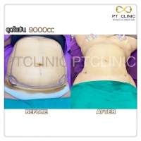 S__131678526.jpg - ดูดไขมัน แผลเล็กมาก เจ็บน้อย ชิวชิว ไม่ต้องวางยา | https://ptinfinity.com