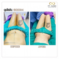 S__131678527.jpg - ดูดไขมัน แผลเล็กมาก เจ็บน้อย ชิวชิว ไม่ต้องวางยา | https://ptinfinity.com