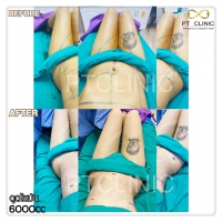 S__131678528.jpg - ดูดไขมัน แผลเล็กมาก เจ็บน้อย ชิวชิว ไม่ต้องวางยา | https://ptinfinity.com