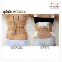 S__131678529.jpg - ดูดไขมัน แผลเล็กมาก เจ็บน้อย ชิวชิว ไม่ต้องวางยา | https://ptinfinity.com