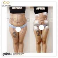 S__131678530.jpg - ดูดไขมัน แผลเล็กมาก เจ็บน้อย ชิวชิว ไม่ต้องวางยา | https://ptinfinity.com