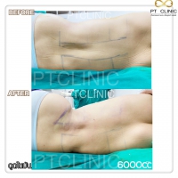 S__131678531.jpg - ดูดไขมัน แผลเล็กมาก เจ็บน้อย ชิวชิว ไม่ต้องวางยา | https://ptinfinity.com