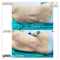 S__131678533.jpg - ดูดไขมัน แผลเล็กมาก เจ็บน้อย ชิวชิว ไม่ต้องวางยา | https://ptinfinity.com