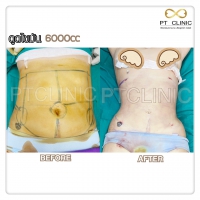 S__131678534.jpg - ดูดไขมัน แผลเล็กมาก เจ็บน้อย ชิวชิว ไม่ต้องวางยา | https://ptinfinity.com