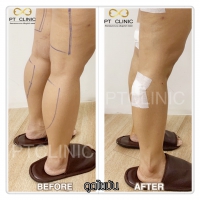 S__131678538.jpg - ดูดไขมัน แผลเล็กมาก เจ็บน้อย ชิวชิว ไม่ต้องวางยา | https://ptinfinity.com