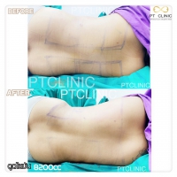 S__131678539.jpg - ดูดไขมัน แผลเล็กมาก เจ็บน้อย ชิวชิว ไม่ต้องวางยา | https://ptinfinity.com