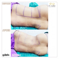 S__131678540.jpg - ดูดไขมัน แผลเล็กมาก เจ็บน้อย ชิวชิว ไม่ต้องวางยา | https://ptinfinity.com