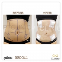 S__131678541.jpg - ดูดไขมัน แผลเล็กมาก เจ็บน้อย ชิวชิว ไม่ต้องวางยา | https://ptinfinity.com