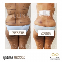 S__131678542.jpg - ดูดไขมัน แผลเล็กมาก เจ็บน้อย ชิวชิว ไม่ต้องวางยา | https://ptinfinity.com