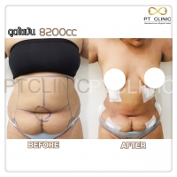 S__131678543.jpg - ดูดไขมัน แผลเล็กมาก เจ็บน้อย ชิวชิว ไม่ต้องวางยา | https://ptinfinity.com