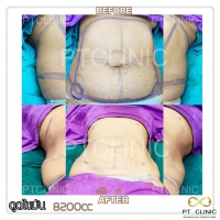 S__131678544.jpg - ดูดไขมัน แผลเล็กมาก เจ็บน้อย ชิวชิว ไม่ต้องวางยา | https://ptinfinity.com