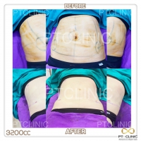 S__131678545.jpg - ดูดไขมัน แผลเล็กมาก เจ็บน้อย ชิวชิว ไม่ต้องวางยา | https://ptinfinity.com