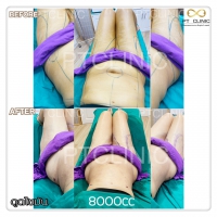 S__131678546.jpg - ดูดไขมัน แผลเล็กมาก เจ็บน้อย ชิวชิว ไม่ต้องวางยา | https://ptinfinity.com