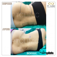 S__131678547.jpg - ดูดไขมัน แผลเล็กมาก เจ็บน้อย ชิวชิว ไม่ต้องวางยา | https://ptinfinity.com