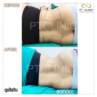 S__131678550.jpg - ดูดไขมัน แผลเล็กมาก เจ็บน้อย ชิวชิว ไม่ต้องวางยา | https://ptinfinity.com