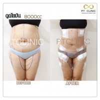 S__131678551.jpg - ดูดไขมัน แผลเล็กมาก เจ็บน้อย ชิวชิว ไม่ต้องวางยา | https://ptinfinity.com