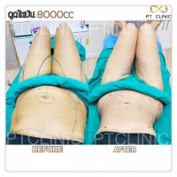 S__131678552.jpg - ดูดไขมัน แผลเล็กมาก เจ็บน้อย ชิวชิว ไม่ต้องวางยา | https://ptinfinity.com