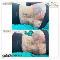 S__131678554.jpg - ดูดไขมัน แผลเล็กมาก เจ็บน้อย ชิวชิว ไม่ต้องวางยา | https://ptinfinity.com