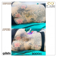 S__131678555.jpg - ดูดไขมัน แผลเล็กมาก เจ็บน้อย ชิวชิว ไม่ต้องวางยา | https://ptinfinity.com