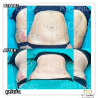 S__131678556.jpg - ดูดไขมัน แผลเล็กมาก เจ็บน้อย ชิวชิว ไม่ต้องวางยา | https://ptinfinity.com