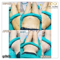 S__131678557.jpg - ดูดไขมัน แผลเล็กมาก เจ็บน้อย ชิวชิว ไม่ต้องวางยา | https://ptinfinity.com