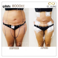 S__131678558.jpg - ดูดไขมัน แผลเล็กมาก เจ็บน้อย ชิวชิว ไม่ต้องวางยา | https://ptinfinity.com