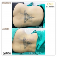 S__131678560.jpg - ดูดไขมัน แผลเล็กมาก เจ็บน้อย ชิวชิว ไม่ต้องวางยา | https://ptinfinity.com