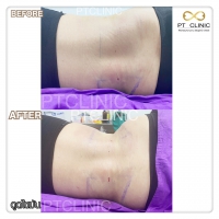 S__131678561.jpg - ดูดไขมัน แผลเล็กมาก เจ็บน้อย ชิวชิว ไม่ต้องวางยา | https://ptinfinity.com