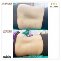 S__131678562.jpg - ดูดไขมัน แผลเล็กมาก เจ็บน้อย ชิวชิว ไม่ต้องวางยา | https://ptinfinity.com