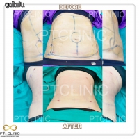 S__131678563.jpg - ดูดไขมัน แผลเล็กมาก เจ็บน้อย ชิวชิว ไม่ต้องวางยา | https://ptinfinity.com