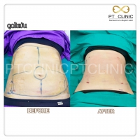 S__131678564.jpg - ดูดไขมัน แผลเล็กมาก เจ็บน้อย ชิวชิว ไม่ต้องวางยา | https://ptinfinity.com