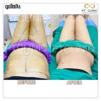 S__131678565.jpg - ดูดไขมัน แผลเล็กมาก เจ็บน้อย ชิวชิว ไม่ต้องวางยา | https://ptinfinity.com