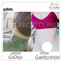 S__131678566.jpg - ดูดไขมัน แผลเล็กมาก เจ็บน้อย ชิวชิว ไม่ต้องวางยา | https://ptinfinity.com